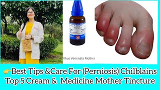 Chilblains Perniosis Swollen FingersToes Best Treatments  Chilblains Best Homeopathic Medicine [upl. by Akenaj]