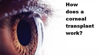 How is a corneal transplant done [upl. by Yslek]