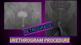 Retrograde Urethrogram Procedure  X ray Urethrogam  Urine Blockage [upl. by Marko621]