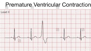 Premature Ventricular Contractions  PVC [upl. by Akilaz894]