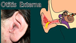 Swimmers Ear Otitis Externa Causes Diagnosis Treatment [upl. by Antonia184]