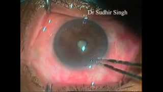 How Releasable Suture In Trabeculectomy is Released By Dr Sudhir Singh 101 [upl. by Nywles578]