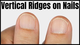 Vertical Ridges on Nails Causes Signs and Treatment [upl. by Enajyram]