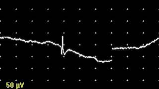 Positive Waves and Fibrillation Potentials [upl. by Ydoow]