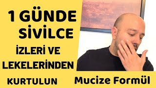 Sivilce Nasıl Geçer   Sivilce İzleri ve Lekelerinden 1 Günde Kurtulun   Bitkisel Kesin Çözüm [upl. by Ilatfen]