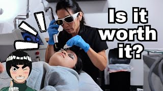 Getting my eyebrows removed laser tattoo removal [upl. by Clemence]