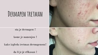 Dermapen tretman  moje iskustvo  demo [upl. by Gerard]