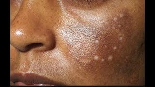 WAJIGA HARAHA LEH SIIDA LOGA NADIIFIYO HYPERPIGMENTATION CURE [upl. by Nilrem]