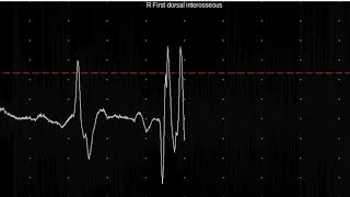 EMG teaching video 20 Myotonia [upl. by Riamo747]