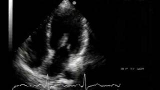 echocardiogram  chordal rupture 22 [upl. by Gipson]