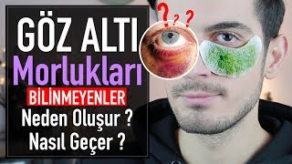 Göz Altı Morlukları Neden Oluşur ve Nasıl Geçer  MUHTEŞEM DOĞAL MASKE [upl. by Gayel]