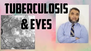 TUBERCULOSIS AND EYES Tuberculosis EyeinfectionRifampicinisoniazidethambutol [upl. by Duster773]