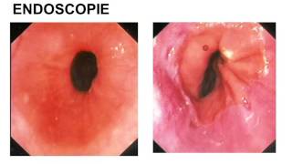 reflux gastro oesophagien et allergie alimentaire partie 2 [upl. by Raskin586]