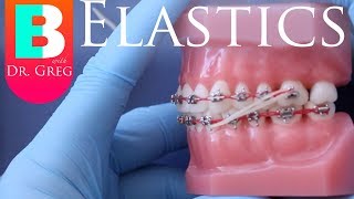 BRACES EXPLAINED Elastics  Rubber Bands [upl. by Irrok]