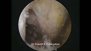 ALL INSIDE PCL RECONSTRUCTION USING PERONEUS LONGUS AUTOGRAFT [upl. by Arym]