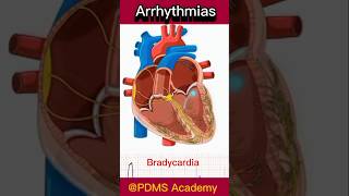 Cardiac Arrhythmia  Arrhythmias overview medicine humanbody [upl. by Anahahs]