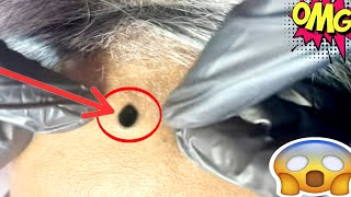 blackheads extractions  blackheads extractions [upl. by Yddur]