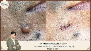 Suturing with 8  0 Ethilon by Dr Uzzaif Mansuri [upl. by Anale]