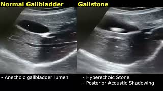 Gallstone Ultrasound RealTime Scan Normal Vs Abnormal Appearance  Cholelithiasis  Gallbladder USG [upl. by Newnorb351]