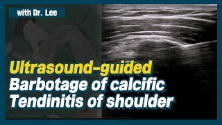 TrailerUltrasoundguided lavage of calcific tendinitis of shoulder ruptured calcification [upl. by Danielle]