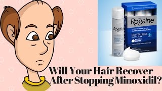 Will Your Hair Recover After Stopping Minoxidil [upl. by Yemirej536]