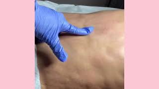 Fibrosis Treatment after liposuction [upl. by Nnaeed59]