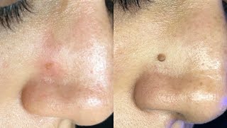 Fibroblast Treatment UPDATE 12 weeks after treatment [upl. by Delahk]