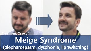 Meige syndrome  blepharospasm  dysphonia  lip twitching  메이그 중후군  디스토니아 치료사례 [upl. by Panayiotis]