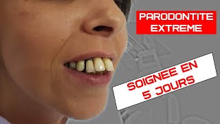 Soigner la parodontite avec perte de gencive  Implants dentaires basales non invasif [upl. by Nitsugua759]