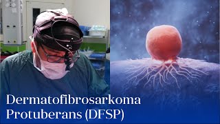 “Dermatofibrosarkoma Protuberans DFSP”  UzmDrDilqəm Məmmədov [upl. by Eva]