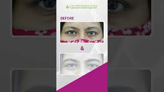 Microblading Before amp After Results  The Ultimate Transformation  Care Well Medical Centre shorts [upl. by Yartnod671]