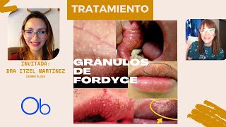 Tratamientos para los GRÁNULOS DE FORDYCE [upl. by Cyndia]