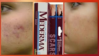 Mederma skin cream review  Scar ointment gel Mederma [upl. by Andreas]