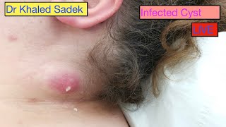 Head Cyst Compilation Live DR Khaled Sadek [upl. by Notgnilliw]