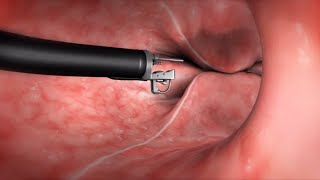 What Happens During the Endoscopic Sleeve Gastroplasty ESG Procedure [upl. by Hardej366]