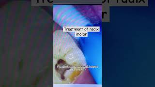 drpriyadarshika rootcanaltreatment phorniixdentalcare radixmolar [upl. by Adnauqaj117]