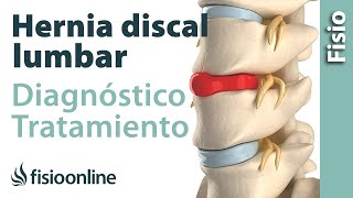 Hernia discal lumbar  Diagnóstico consejos ejercicios y tratamiento de fisioterapia [upl. by Asum]