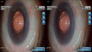 Redialing and optic capture Dr Sourabh Patwardhan Live Cataract surgery For 7028402375 [upl. by Nnylrac488]