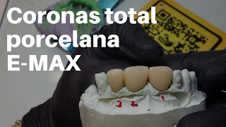 Coronas Dentales EMax TOTAL PORCELANA👅PASOS para CementaciónAdhesión CoronasDentales [upl. by Kantos]