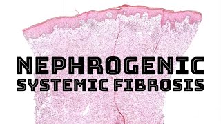 Nephrogenic systemic fibrosis from Gadolinium MRI contrast pathology dermatology dermatopathology [upl. by Nagam869]