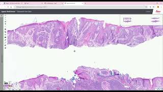 Merkel cell carcinoma in situ MCCis dermpath [upl. by Egor]