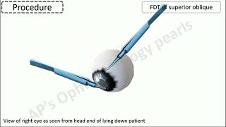 forced duction test untuk muscle entrapment orbita [upl. by Joy]