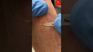 How podiatrists remove hard skin from bunions [upl. by Tnecnev]