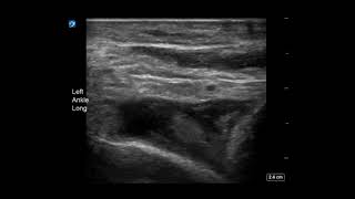 Ankle Ultrasound Joint Effusion Long Axis [upl. by Amla783]