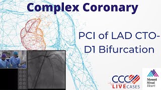 PCI of LAD CTOD1 Bifurcation  November 2017 [upl. by Humphrey]