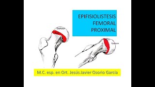 Epifisiolistesis Femoral [upl. by Adnalahs]