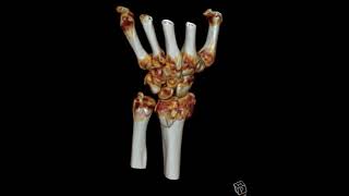 Comminuted distal radius fracture [upl. by Areyk]