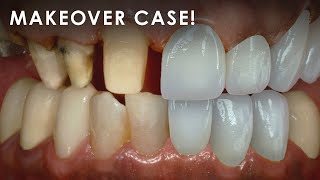 How a Dental Lab Fabricates a Makeover Case [upl. by Audwin]