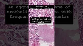 Micropapillary urothelial carcinoma is an aggressive subtype of bladder cancer [upl. by Ancalin635]