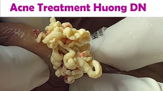 Acne Treatment Huong Da Nang  2024 Acne Huong 715 [upl. by Patton]